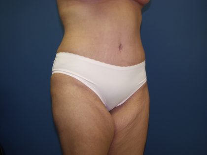 Tummy Tuck Before & After Patient #2251