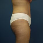 Tummy Tuck Before & After Patient #2251