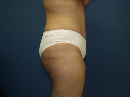 Tummy Tuck Before & After Patient #2251