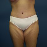 Tummy Tuck Before & After Patient #2251
