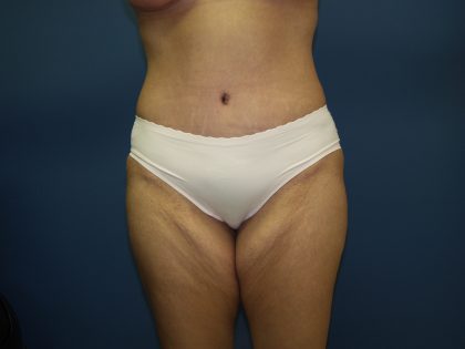 Tummy Tuck Before & After Patient #2251