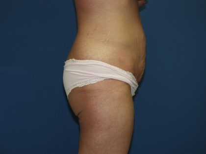 Tummy Tuck Before & After Patient #2251