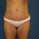 Tummy Tuck Before & After Patient #2251