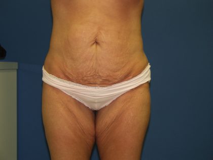 Tummy Tuck Before & After Patient #2251