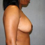 Breast Reduction Before & After Patient #3408