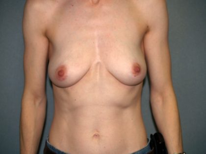 Breast Reconstruction Before & After Patient #1775