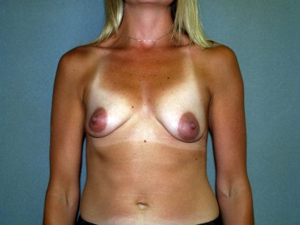 Breast Lift with Implant Before & After Patient #1688