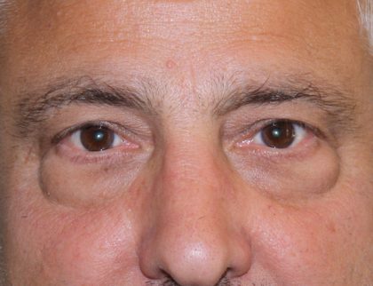 Eye Lid Lift Before & After Patient #685