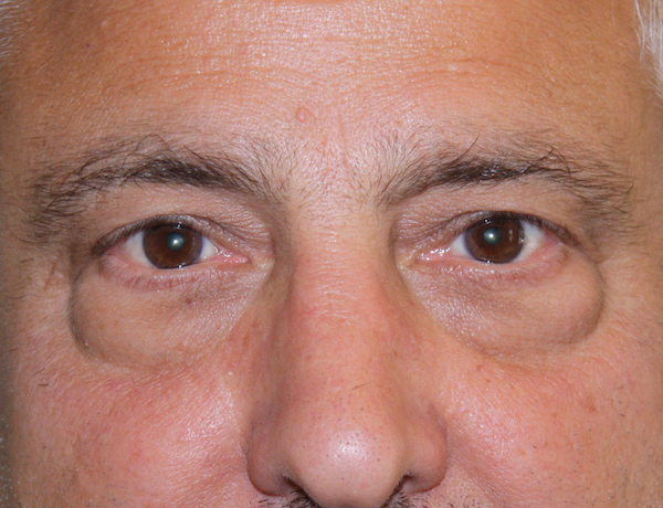 Eye Lid Lift Before & After Patient #685