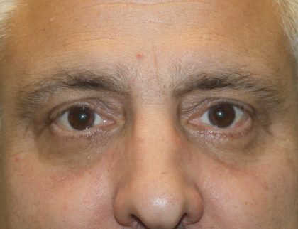 Eye Lid Lift Before & After Patient #685