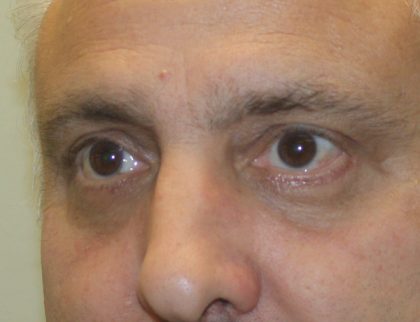 Eye Lid Lift Before & After Patient #685