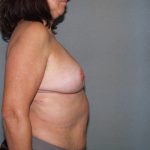 Breast Reconstruction Before & After Patient #2081