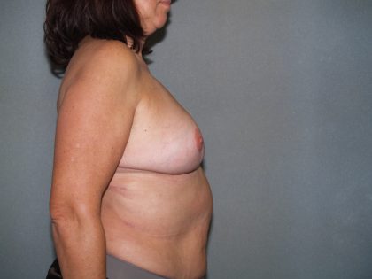 Breast Reconstruction Before & After Patient #2081