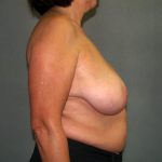 Breast Reconstruction Before & After Patient #2081