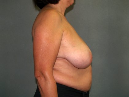 Breast Reconstruction Before & After Patient #2081