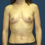 Breast Augmentation Before & After Patient #2920