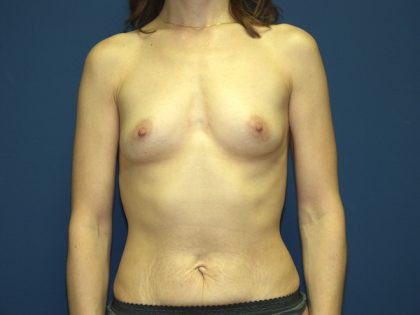 Breast Augmentation Before & After Patient #2920