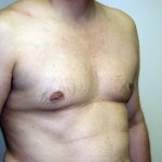 Gynecomastia Before & After Patient #934