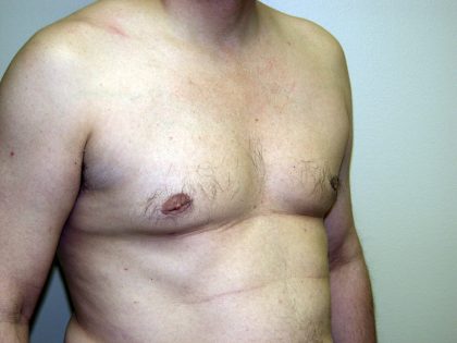 Gynecomastia Before & After Patient #934