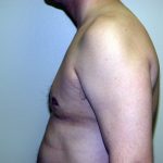 Gynecomastia Before & After Patient #934