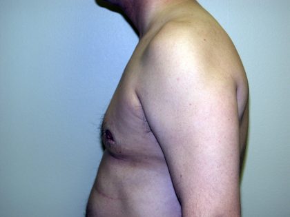 Gynecomastia Before & After Patient #934