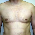 Gynecomastia Before & After Patient #934