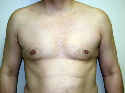 Gynecomastia Before & After Patient #934