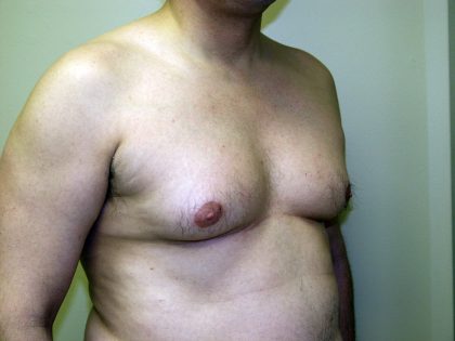 Gynecomastia Before & After Patient #934