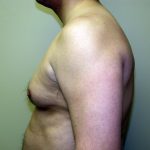 Gynecomastia Before & After Patient #934