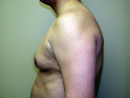 Gynecomastia Before & After Patient #934