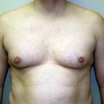 Gynecomastia Before & After Patient #934