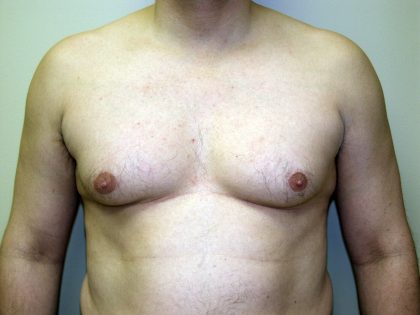 Gynecomastia Before & After Patient #934