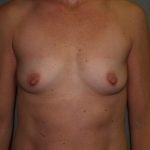 Breast Augmentation Before & After Patient #3146