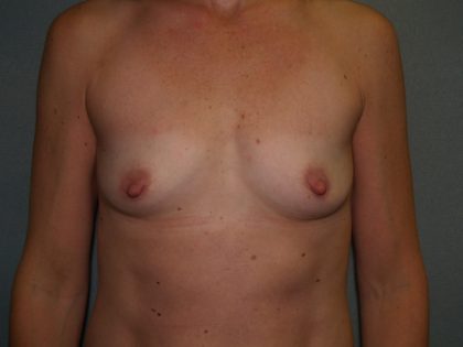 Breast Augmentation Before & After Patient #3146