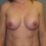 Breast Augmentation Before & After Patient #3146