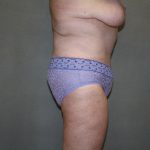 Tummy Tuck Before & After Patient #2237