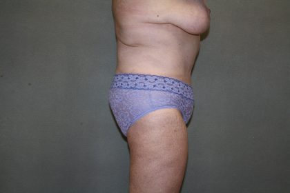 Tummy Tuck Before & After Patient #2237