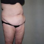 Tummy Tuck Before & After Patient #2237