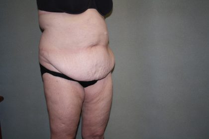 Tummy Tuck Before & After Patient #2237