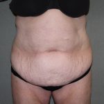 Tummy Tuck Before & After Patient #2237
