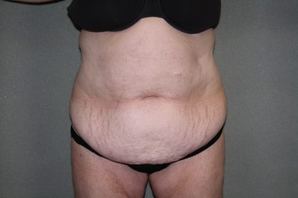 Tummy Tuck Before & After Patient #2237