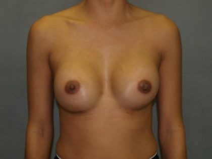 Breast Augmentation Before & After Patient #2447