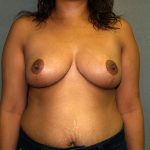 Breast Reduction Before & After Patient #3208