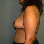 Breast Reduction Before & After Patient #3208