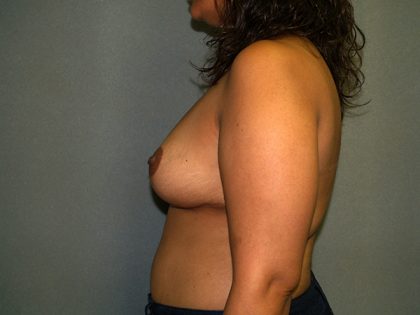 Breast Reduction Before & After Patient #3208