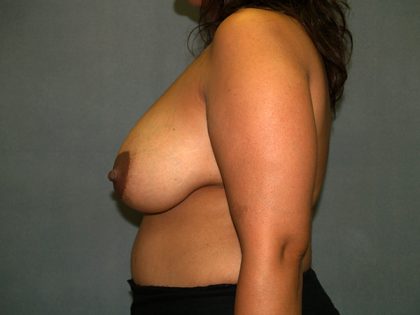 Breast Reduction Before & After Patient #3208