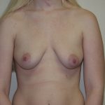 Breast Lift with Implant Before & After Patient #1595
