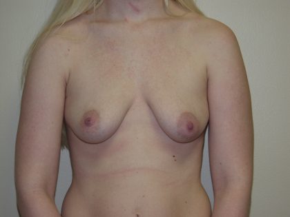 Breast Lift with Implant Before & After Patient #1595