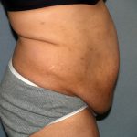 Tummy Tuck Before & After Patient #1969