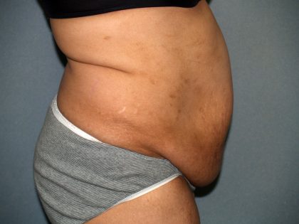 Tummy Tuck Before & After Patient #1969